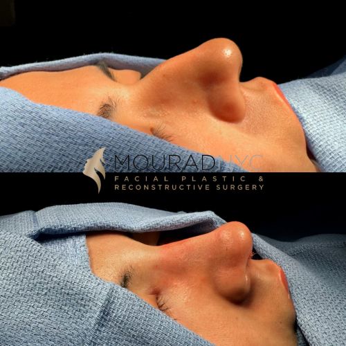 Before and After Rhinoplasty