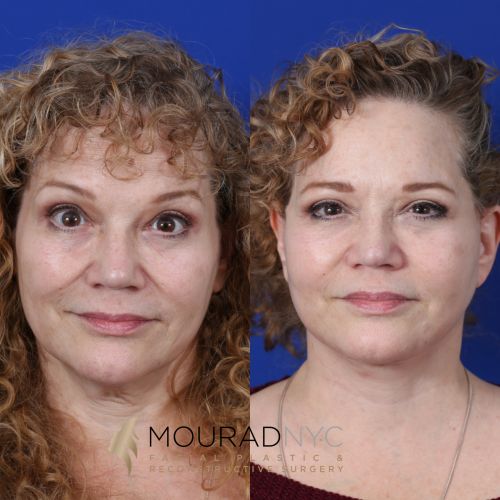 Female Facelift Before and After