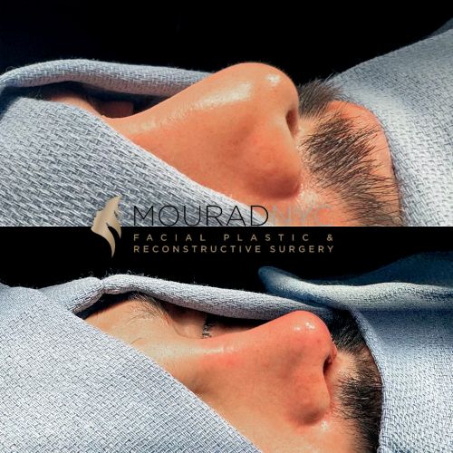 Before and After Major Revision Rhinoplasty