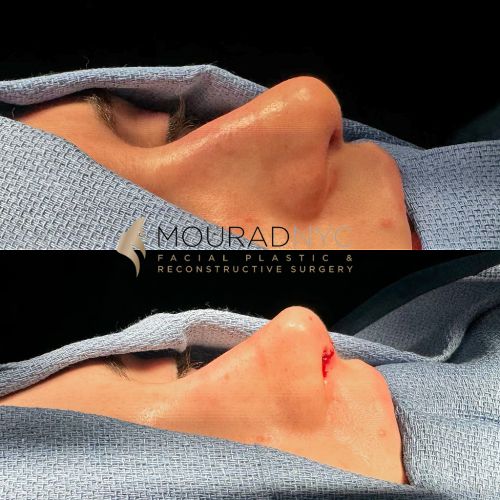 Before and after Rhinoplasty