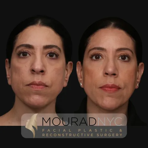 Before and After Female 30s Rhinoplasty