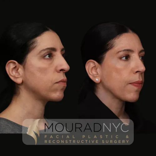 Before and After Female 30s Rhinoplasty