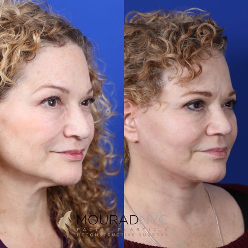 Female Facelift Before and After